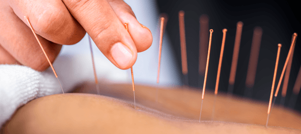 Acupuntura