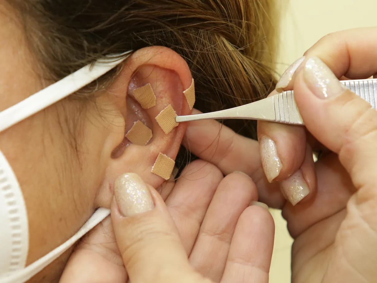 Auriculoterapia